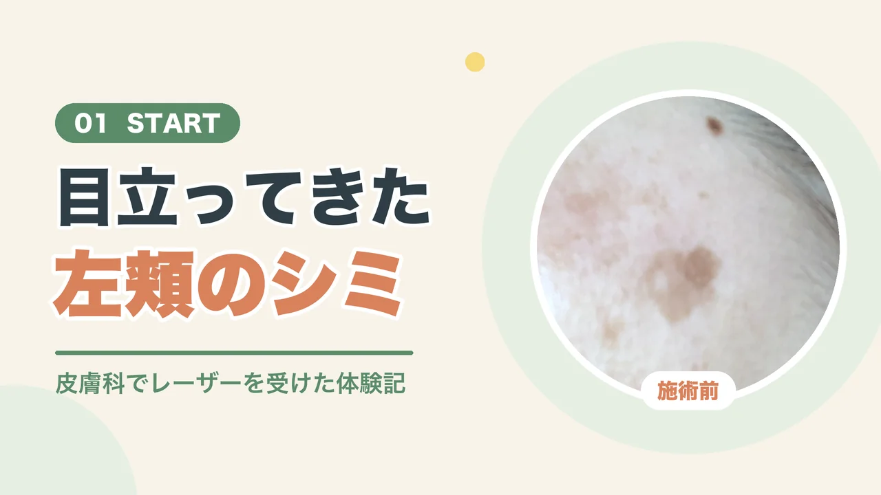 顔のシミ取りを決めた理由（施術前の左頬のシミの写真）