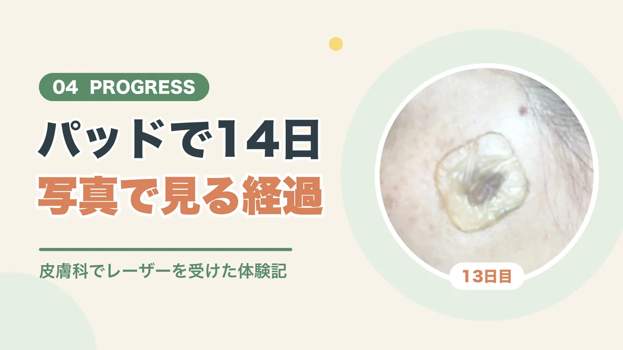 顔のシミ取り後の経過（パッドを貼った13日目の写真）