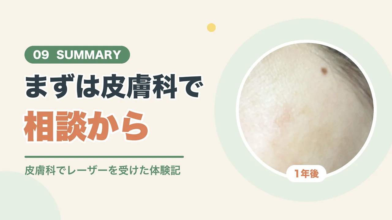 顔のシミ取り体験のまとめ（レーザーから1年後の左頬の写真）