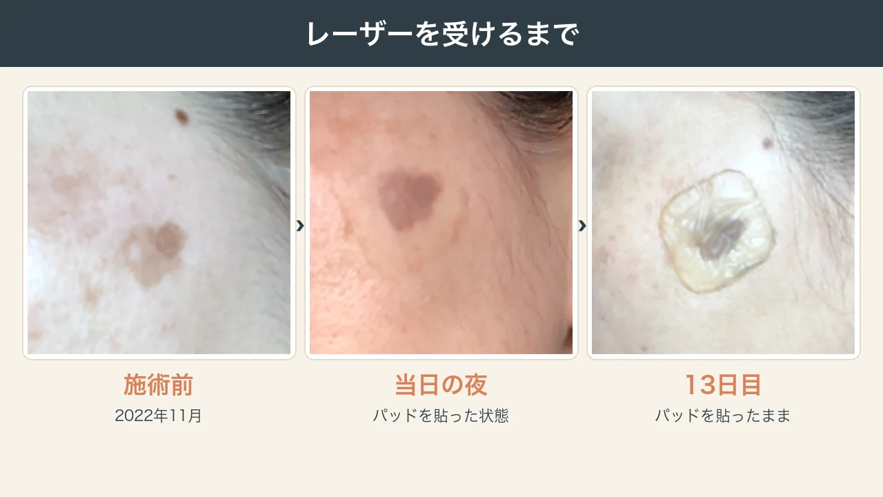 顔のシミ取りレーザーを受けるまでの写真（施術前・当日の夜・パッドを貼った13日目）