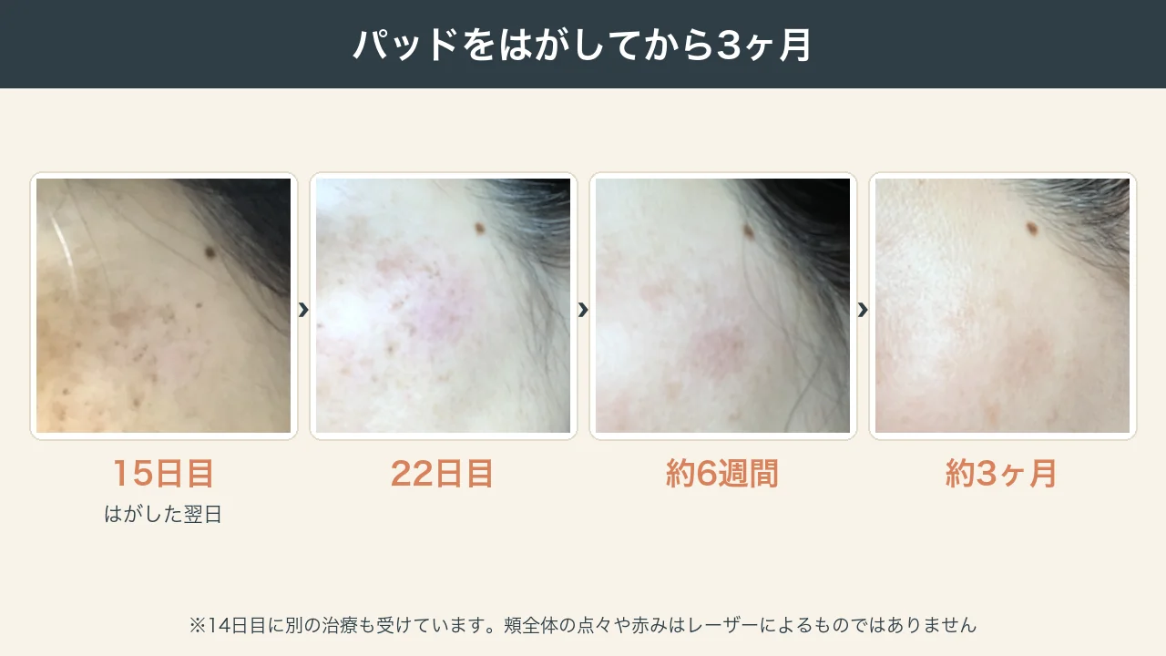 顔のシミ取りレーザーのパッドをはがしてから3ヶ月の経過写真（15日目・22日目・約6週間・約3ヶ月）